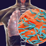Vers un diagnostic « point-of-care » de la tuberculose, directement à partir de l’analyse de l’air exhalé par les patients