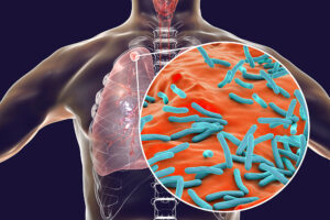 Towards a point-of-care diagnosis of tuberculosis, directly from the analysis of patients’ exhaled air