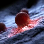 L’électrochimiothérapie sans douleur