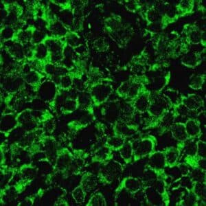 How a rogue immune signal fuels a rare skin cancer, and how to shut it down